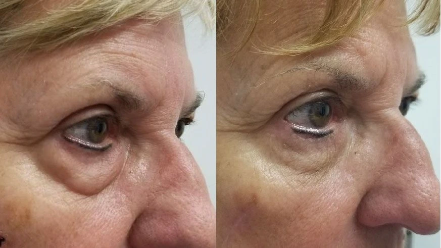 Blépharoplastie